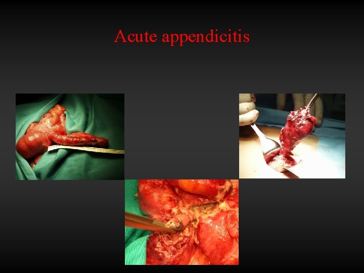 Acute appendicitis 