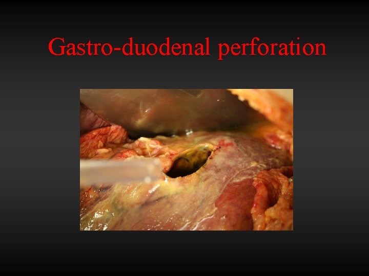 Gastro-duodenal perforation 