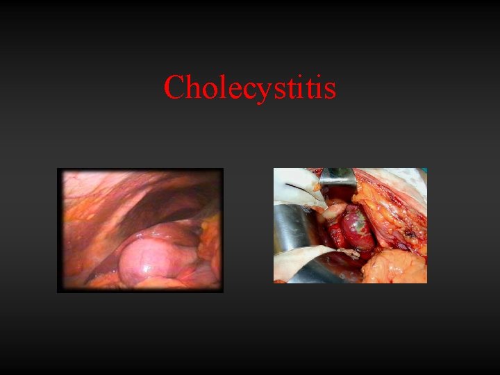 Cholecystitis 