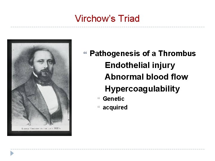 Virchow’s Triad Pathogenesis of a Thrombus Endothelial injury Abnormal blood flow Hypercoagulability Genetic acquired