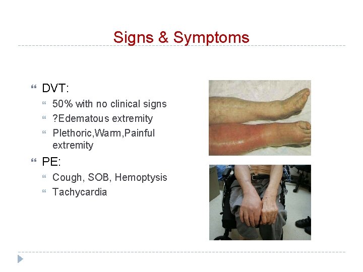 Signs & Symptoms DVT: 50% with no clinical signs ? Edematous extremity Plethoric, Warm,