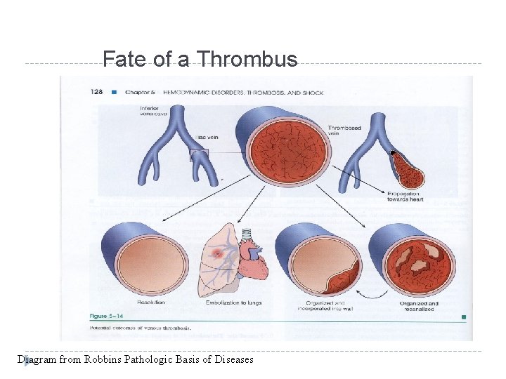 Fate of a Thrombus Diagram from Robbins Pathologic Basis of Diseases 