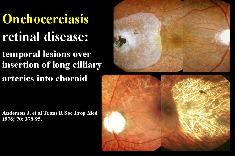 Onchocerciasis retinal disease: temporal lesions over insertion of long cilliary arteries into choroid Anderson