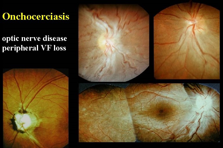 Onchocerciasis optic nerve disease peripheral VF loss 