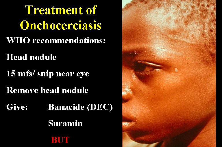 Treatment of Onchocerciasis WHO recommendations: Head nodule 15 mfs/ snip near eye Remove head