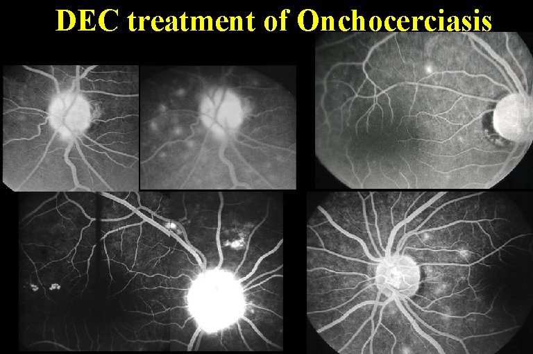 DEC treatment of Onchocerciasis 