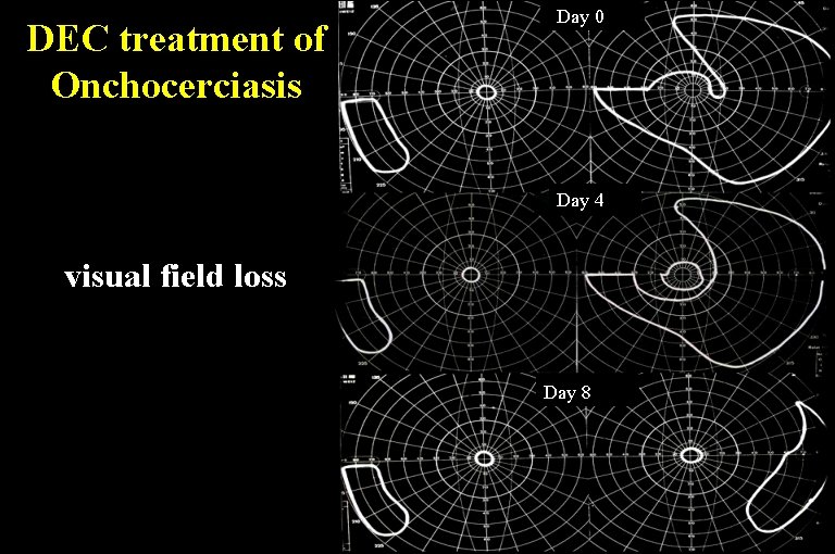 DEC treatment of Onchocerciasis Day 0 Day 4 visual field loss Day 8 