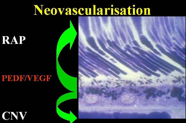 Neovascularisation RAP PEDF/VEGF CNV 