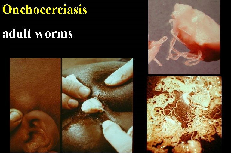 Onchocerciasis adult worms 