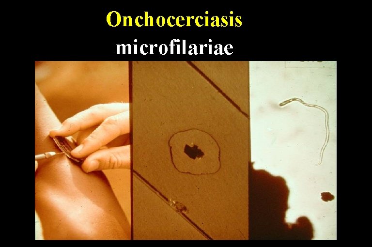 Onchocerciasis microfilariae 