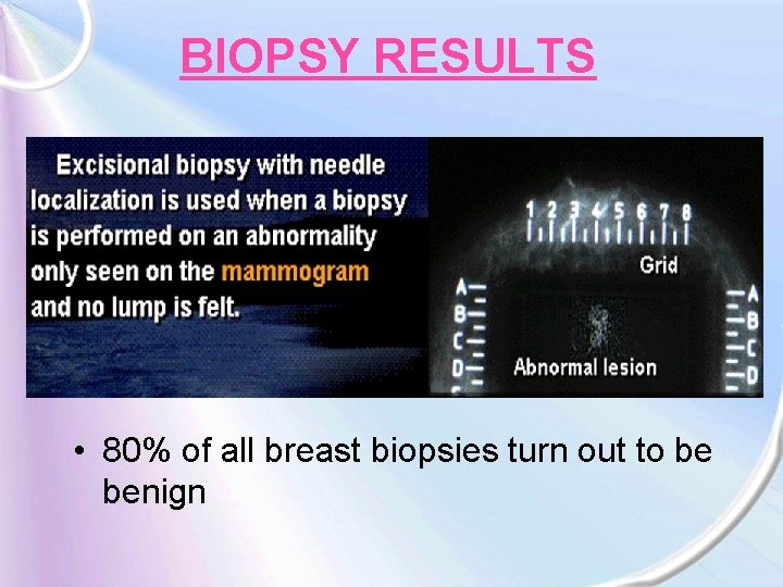 BIOPSY RESULTS • 80% of all breast biopsies turn out to be benign 