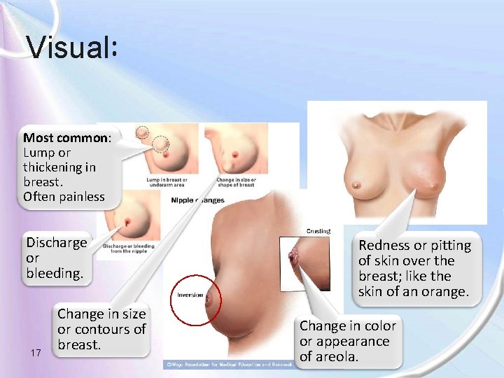 Visual: Most common: Lump or thickening in breast. Often painless Discharge or bleeding. 17