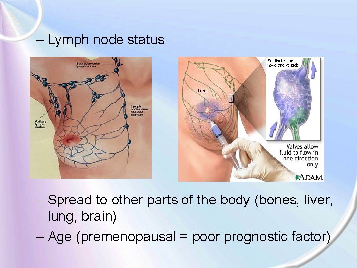 – Lymph node status – Spread to other parts of the body (bones, liver,