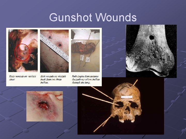 Gunshot Wounds 