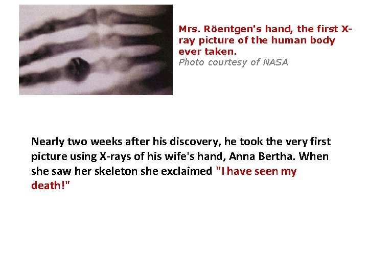 Mrs. Röentgen's hand, the first Xray picture of the human body ever taken. Photo