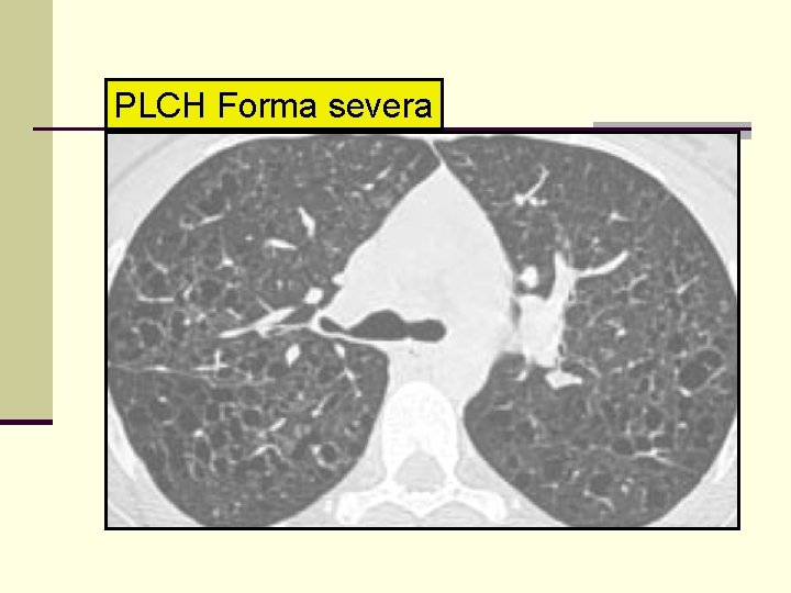 PLCH Forma severa 