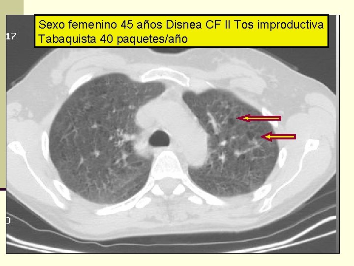 Sexo femenino 45 años Disnea CF II Tos improductiva Tabaquista 40 paquetes/año 