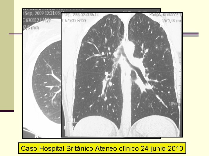 Caso Hospital Británico Ateneo clínico 24 -junio-2010 