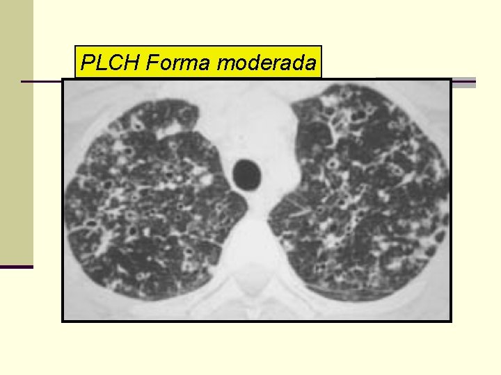 PLCH Forma moderada 