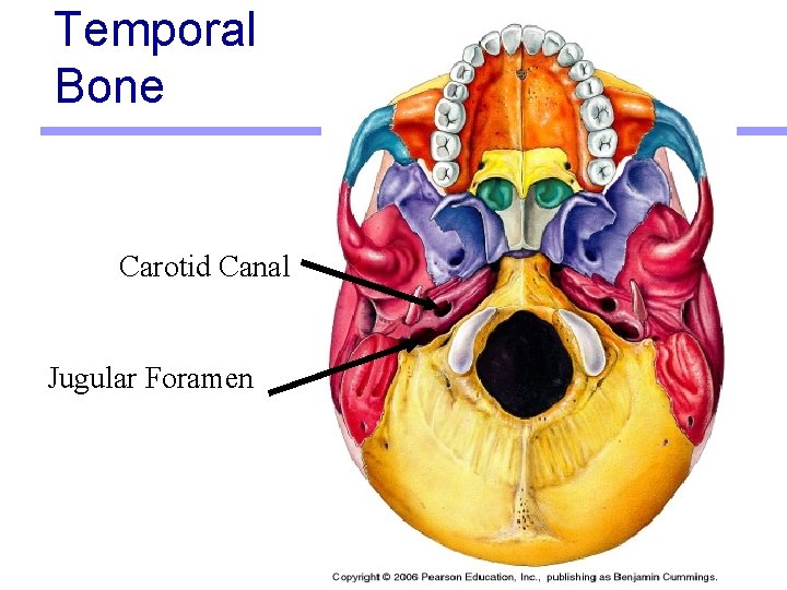 Temporal Bone Carotid Canal Jugular Foramen 
