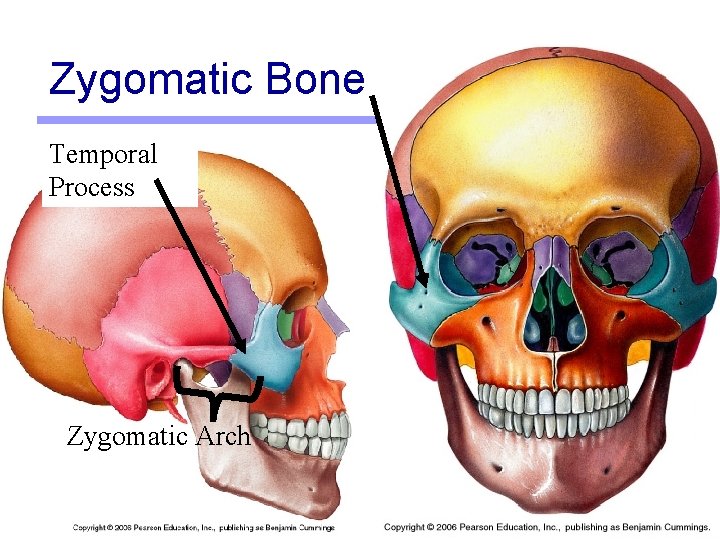 Zygomatic Bone Temporal Process Zygomatic Arch 