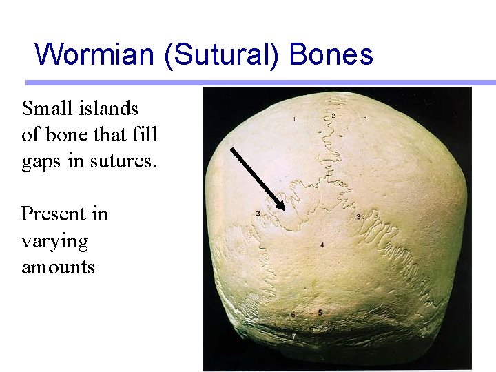 Wormian (Sutural) Bones Small islands of bone that fill gaps in sutures. Present in