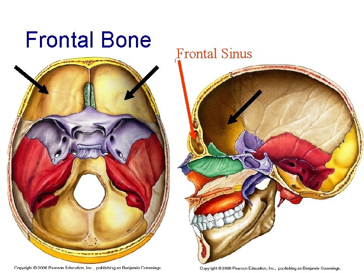 Frontal Bone Frontal Sinus 