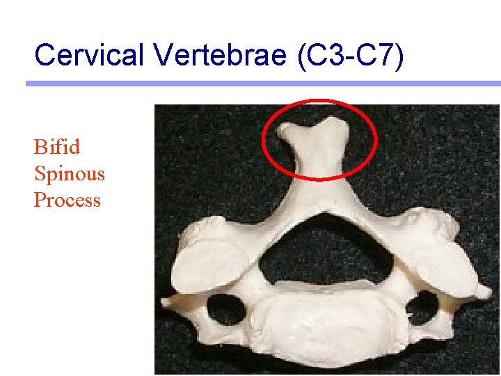 Cervical Vertebrae (C 3 -C 7) Bifid Spinous Process 