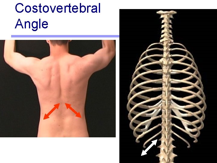 Costovertebral Angle 