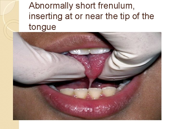 Abnormally short frenulum, inserting at or near the tip of the tongue 
