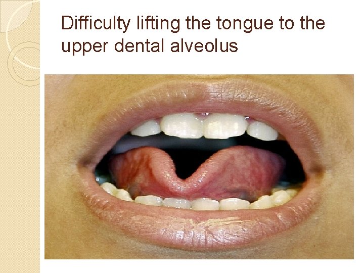 Difficulty lifting the tongue to the upper dental alveolus 