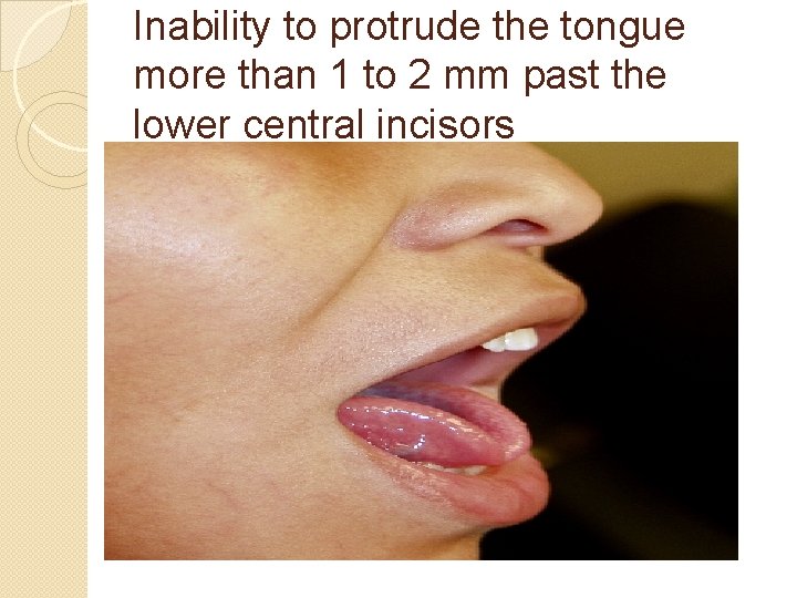 Inability to protrude the tongue more than 1 to 2 mm past the lower
