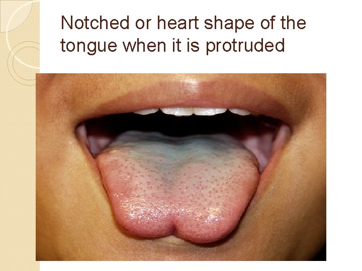 Notched or heart shape of the tongue when it is protruded 