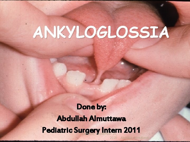 ANKYLOGLOSSIA Done by: Abdullah Almuttawa Pediatric Surgery Intern 2011 Saturday, September 26, 2020 Abdullah