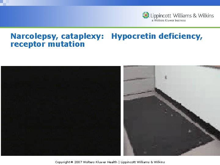 Narcolepsy, cataplexy: receptor mutation Hypocretin deficiency, Copyright © 2007 Wolters Kluwer Health | Lippincott