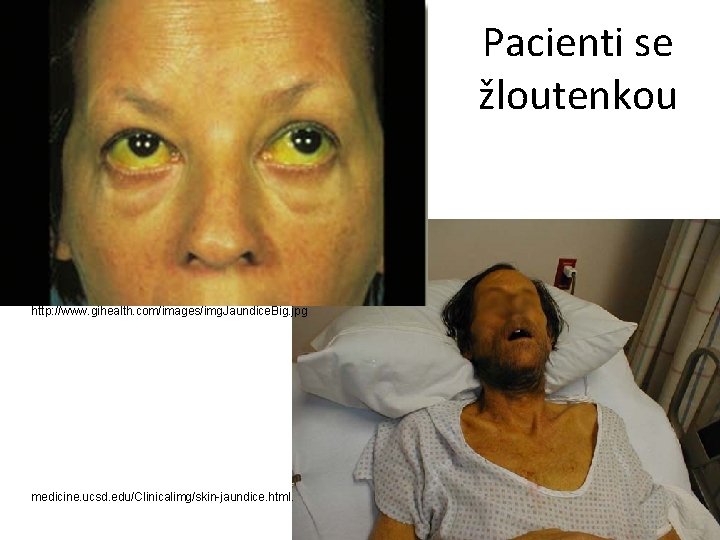 Pacienti se žloutenkou http: //www. gihealth. com/images/img. Jaundice. Big. jpg medicine. ucsd. edu/Clinicalimg/skin-jaundice. html.