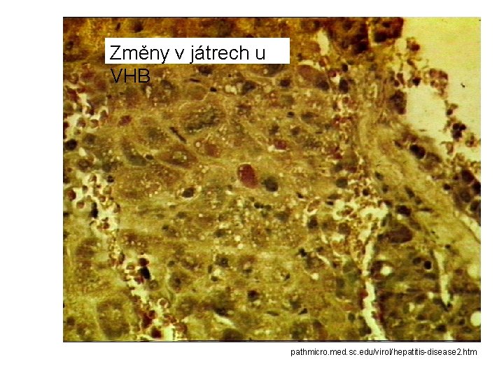 Změny v játrech u VHB pathmicro. med. sc. edu/virol/hepatitis-disease 2. htm 