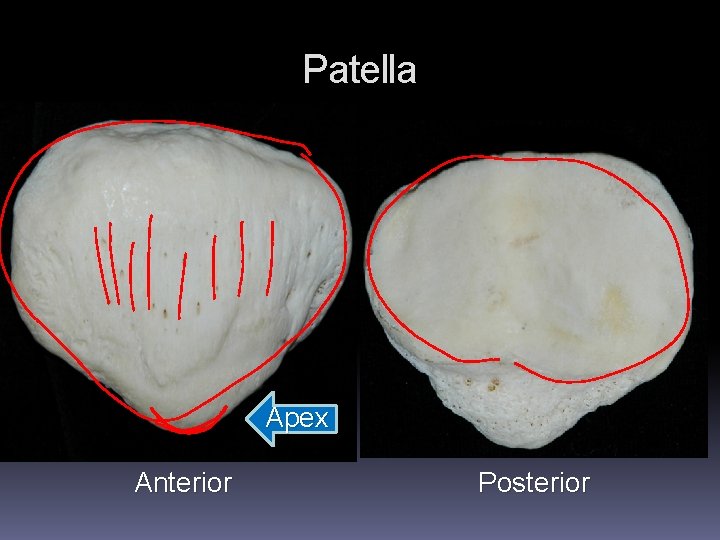 Patella Apex Anterior Posterior Patella Apex Anterior Posterior