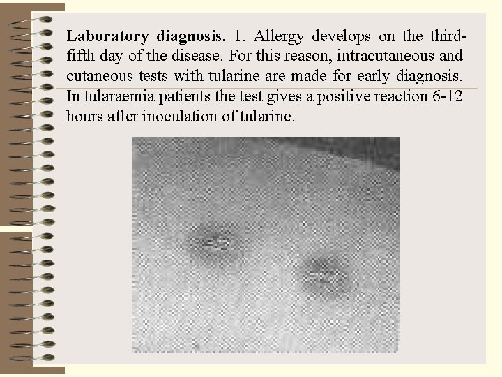 Laboratory diagnosis. 1. Allergy develops on the thirdfifth day of the disease. For this