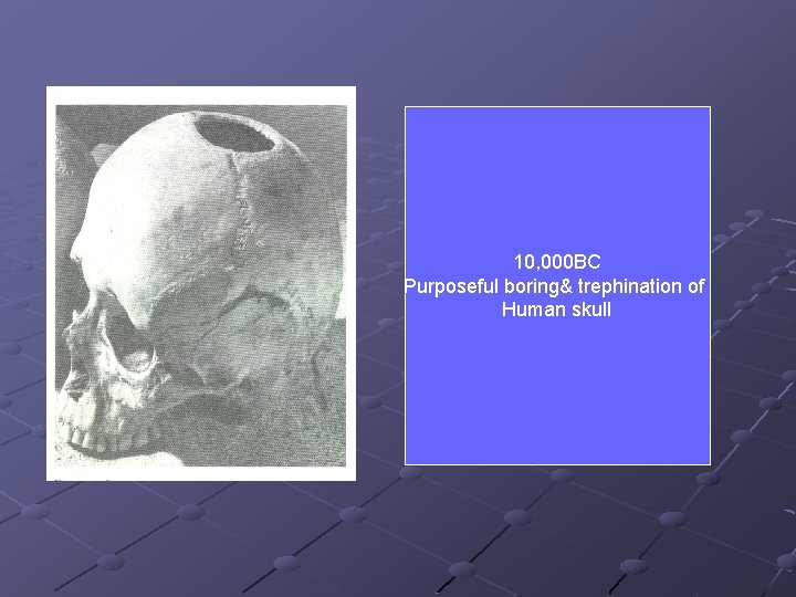 10, 000 BC Purposeful boring& trephination of Human skull 