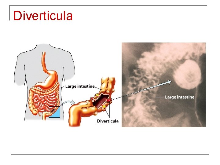 Diverticula 