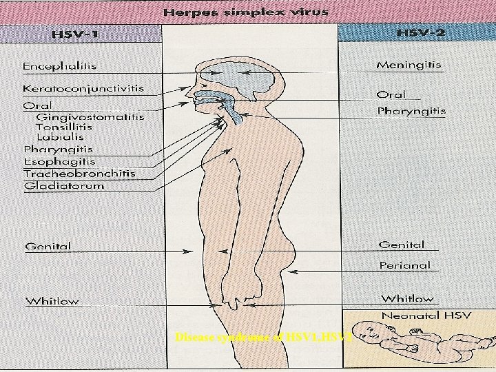 Disease syndrome of HSV 1, HSV 2 