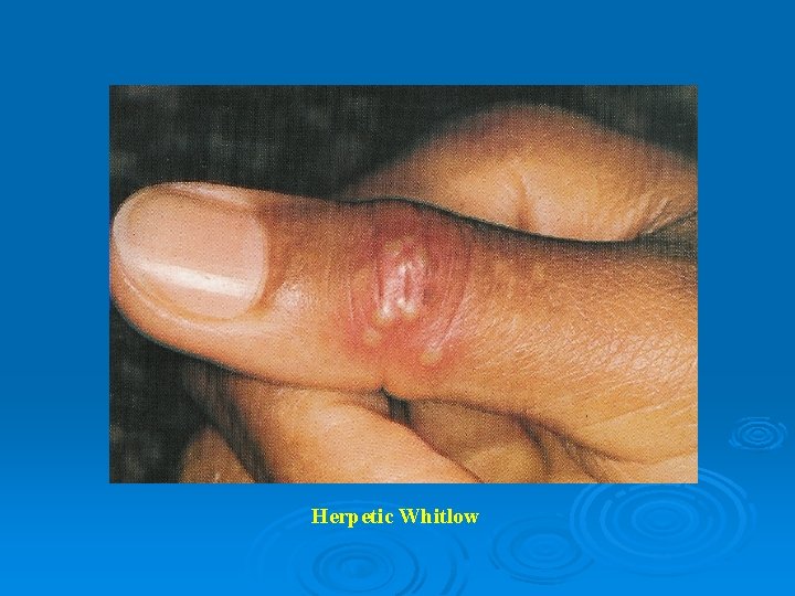 Herpetic Whitlow 