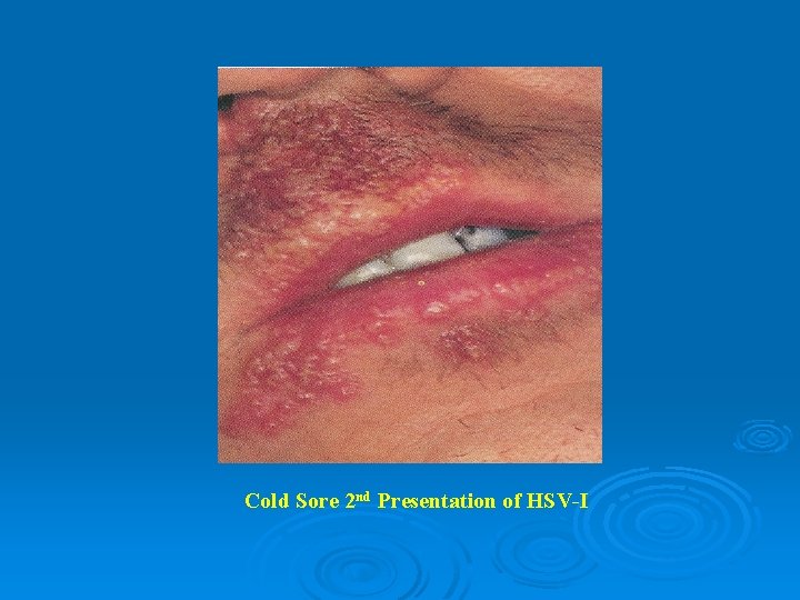 Cold Sore 2 nd Presentation of HSV-I 