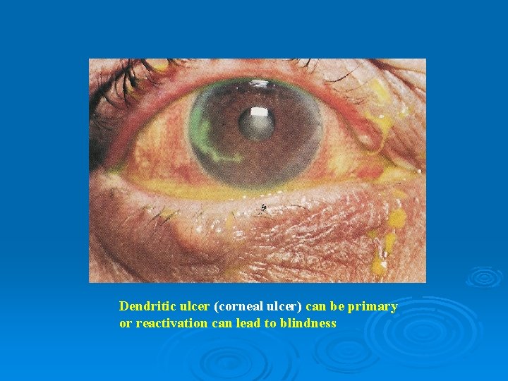 Dendritic ulcer (corneal ulcer) can be primary or reactivation can lead to blindness 