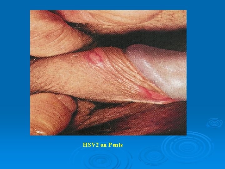 HSV 2 on Penis 