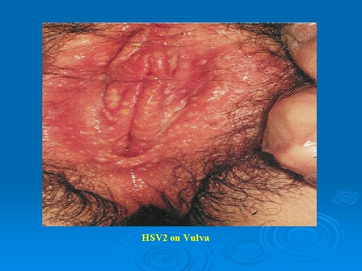 HSV 2 on Vulva 