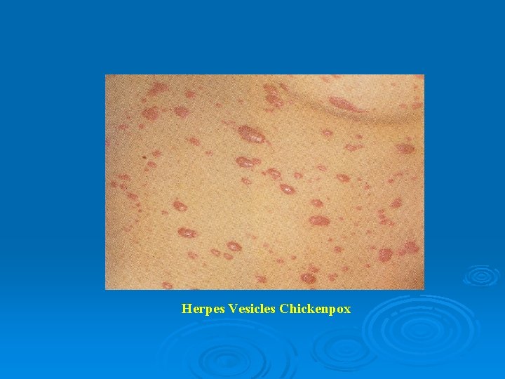Herpes Vesicles Chickenpox 