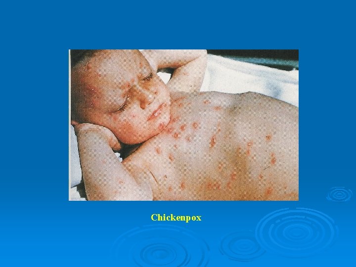 Chickenpox 