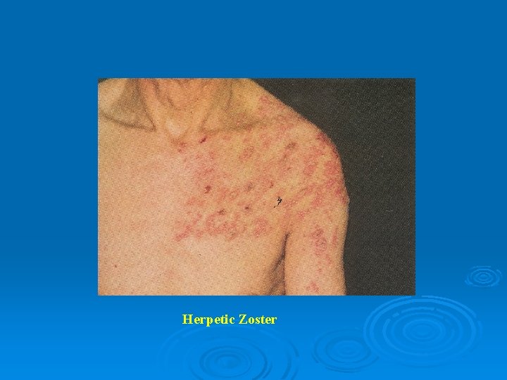 Herpetic Zoster 